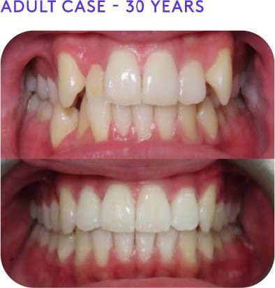 Adult case 30years