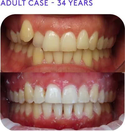 Adult case 34years